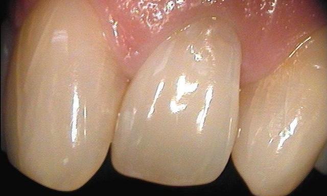 dark tooth brightened after teeth whitening