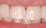 veneers closed large gaps between front teeth
