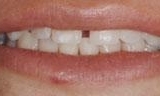 large gap between front teeth