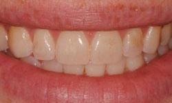 young mother's smile before teeth whitening