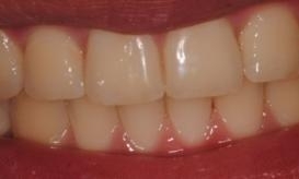 patient before teeth whitening in lincoln