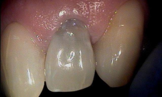 dark tooth before teeth whitening