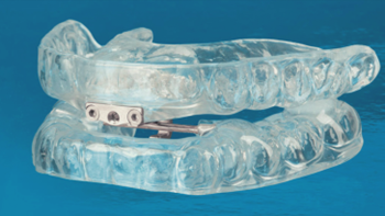 oral appliance for sleep apnea